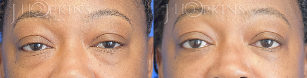 Patient 6 Before and After Blepharoplasty Front View