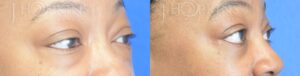 Patient 6 Before and After Blepharoplasty Right Side View