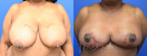 Patient 10 Before and After Breast Reduction Front View