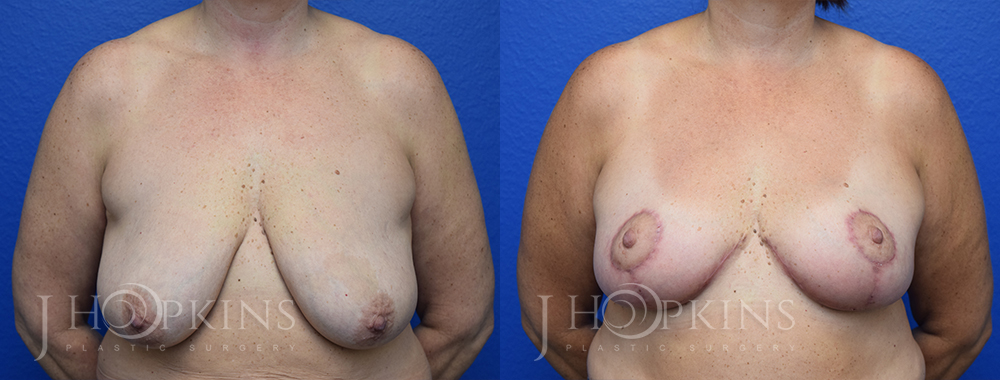 Patient 14 Before and After Breast Reduction Front View