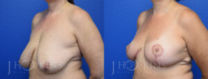 Patient 14 Before and After Breast Reduction Left Side Angle View
