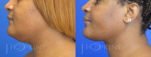 Patient Before and After Chin Lipo Left Side View