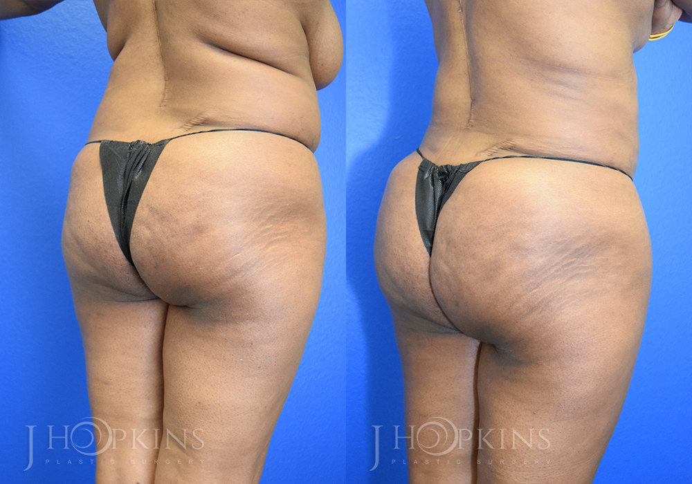 Patient 4 Before and After Fat Transfer Back Right Angle View
