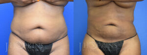 Patient 4 Before and After Fat Transfer Front View