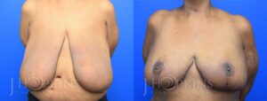 Patient 13 Before and After Breast Reduction Front View