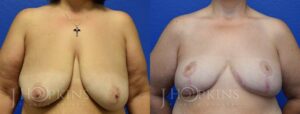 Patient 11 Before and After Breast Reduction Front View
