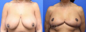 Patient 12 Before and After Breast Reduction Front View