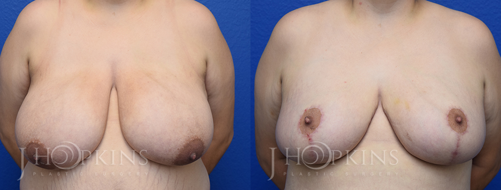Patient 15 Before and After Breast Reduction Front View