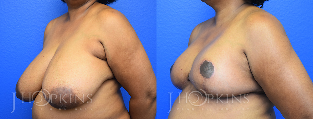 Patient 2 Before and After Side Panniculectomy Left Side Angle View