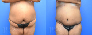 Patient 2 Before and After Side Panniculectomy Front View