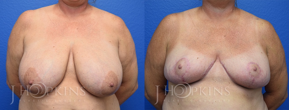 Patient 16 Before and After Breast Reduction Front View