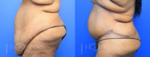 Patient 13 Before and After Panniculectomy Left Side View