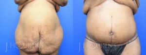 Patient 1b Before and After Panniculectomy