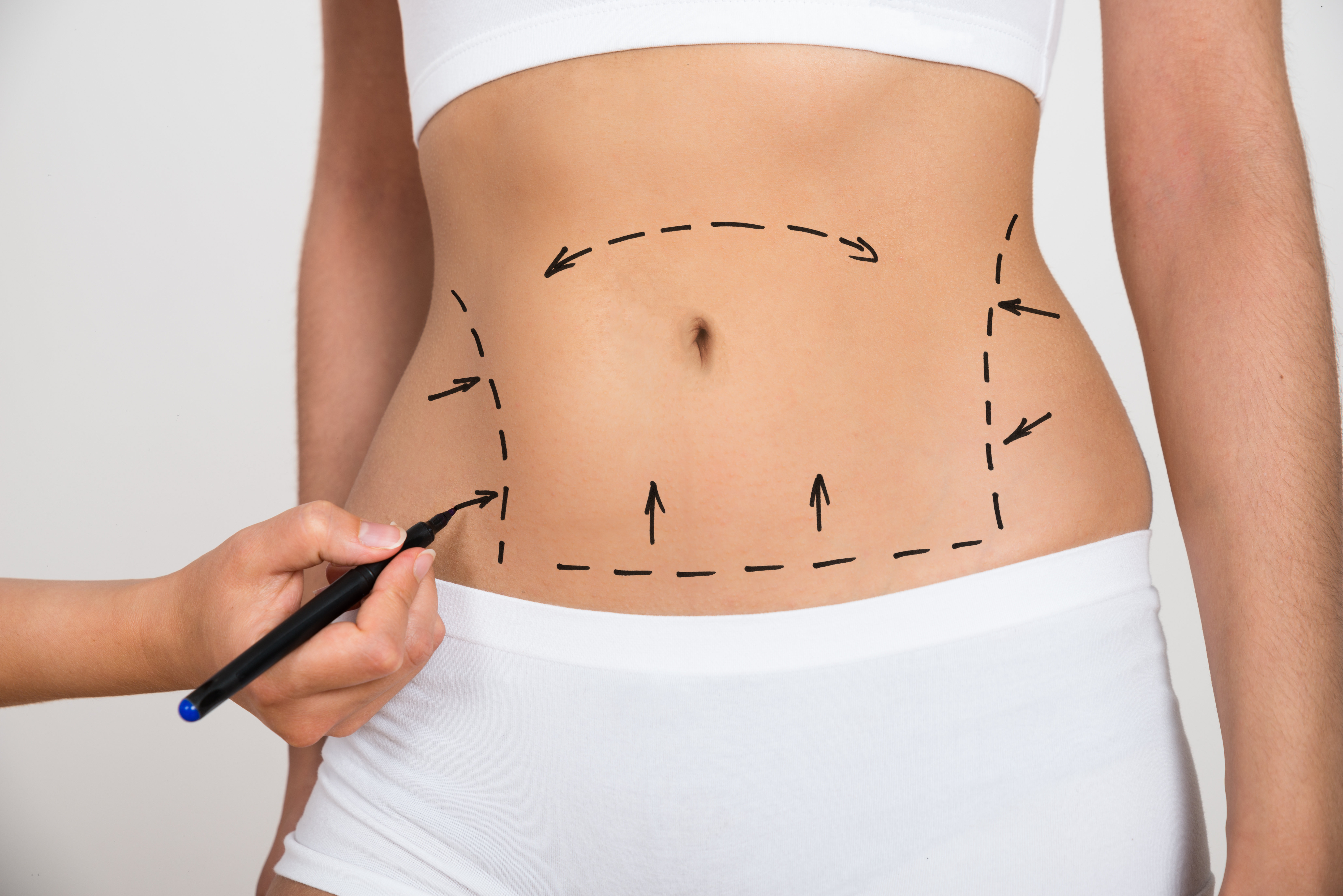 Person Hand Drawing Lines On A Womans Abdomen's Abdomen As Marks For Abdominal Cellulite Correction
