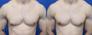 Patient 2 Before and After Male Gynecomastia Front View