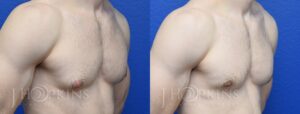 Patient 2 Before and After Male Gynecomastia Right Angle Side View