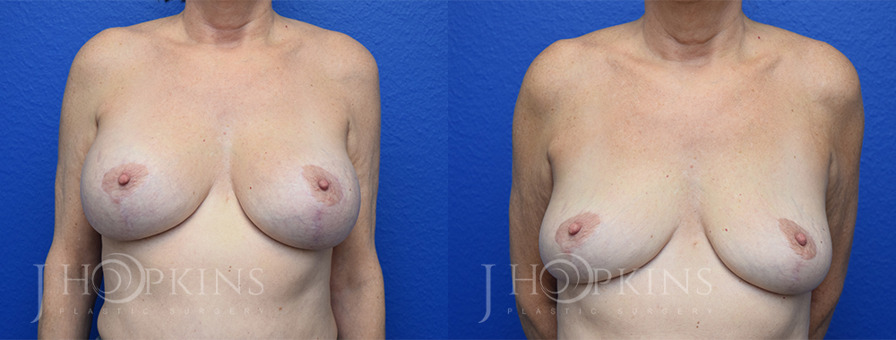 Patient 1 Before and After Breast Implant Removal Front View
