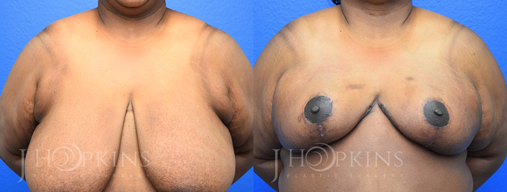 Patient 18 Before and After Breast Reduction Front View
