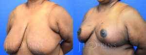 Patient 18 Before and After Breast Reduction Left Side Angle View