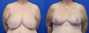 Patient 19 Before and After Breast Reduction Front View