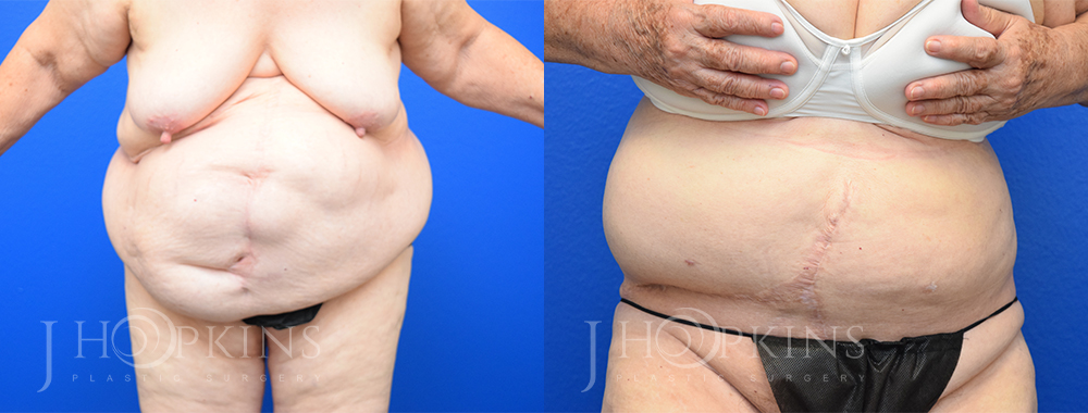Patient 15 Before and After Panniculectomy Front View