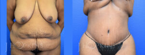 Patient 16 Before and After Panniculectomy Front View