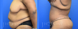 Patient 16 Before and After Panniculectomy Left Side View