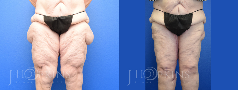 Patient 2 Before and After Thighplasty Front View