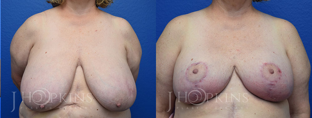 hopkins-dallas-breast-reduction-patient-20-1