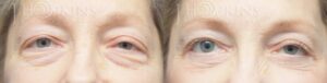 Blepharoplasty-Before-and-After-Photos-Patient-1A