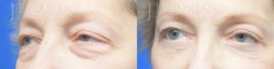 Blepharoplasty-Before-and-After-Photos-Patient-1B-1