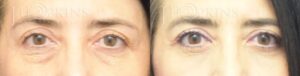 Blepharoplasty-Before-and-After-Photos-Patient-2A
