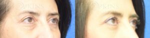 Blepharoplasty-Before-and-After-Photos-Patient-2B