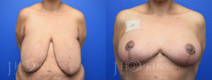 DrJHopkins_DallasTx_BreastReduction_B&A_Patient-23_Front