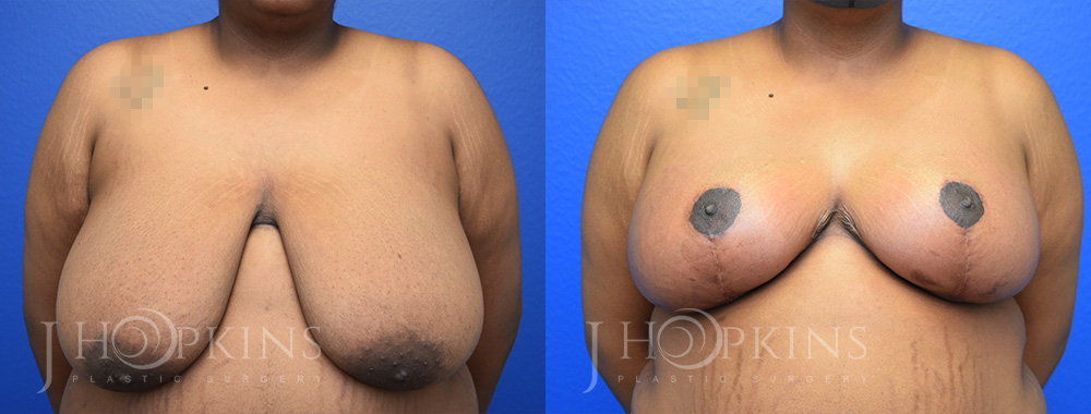 hopkins_dallas_breastreduction_patient01a
