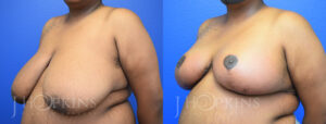 hopkins_dallas_breastreduction_patient01b