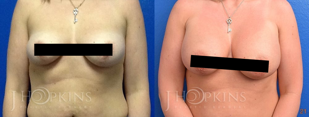 Breast-Augmentation-Before-and-After-Photos-Patient-2a-2_Censored2