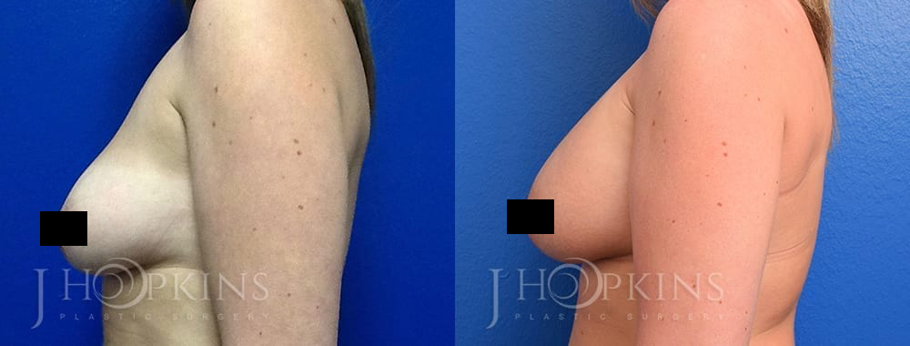 Breast-Augmentation-Before-and-After-Photos-Patient-2b_Censored2