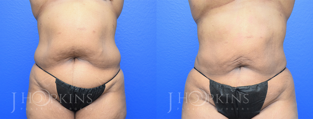 DrJHopkins_DallasTx_Liposuction_B&A_Patient-3_Front