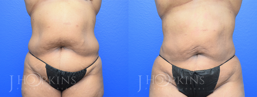 Flank Liposuction: Everything You Need to Know 2024 - International Clinics