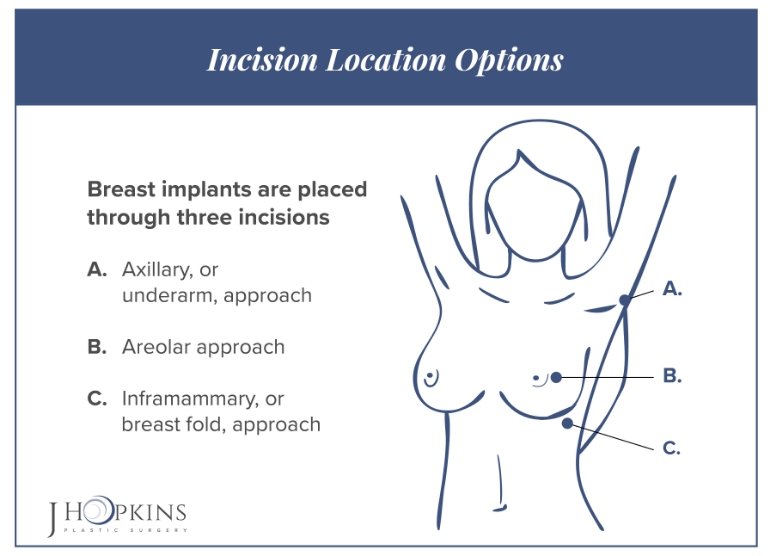 JHopkins Breast augmentation page breast implant incisions icon