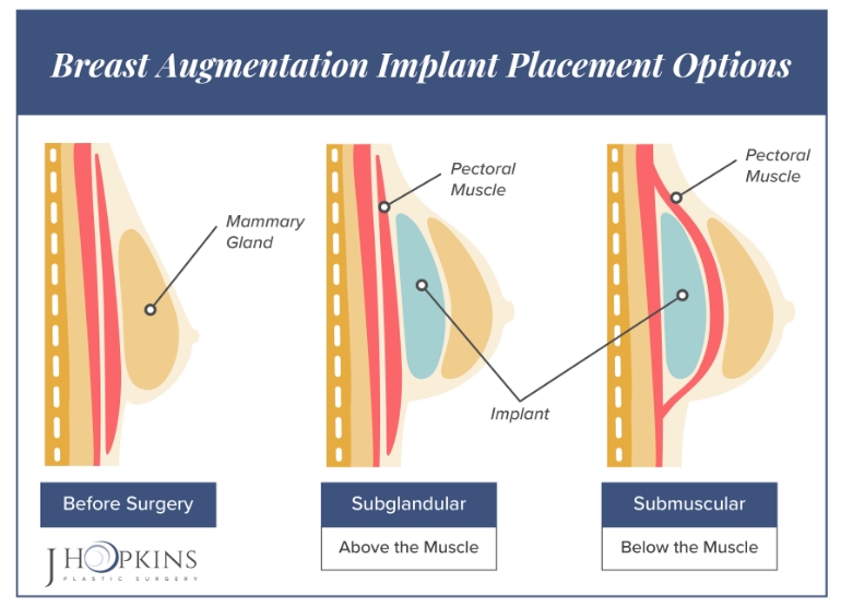 JHopkins Breast augmentation page implant placement icon