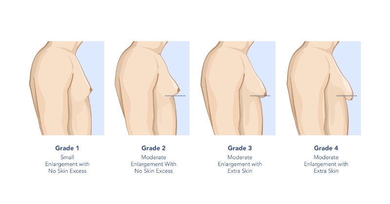 JHopkins gynecomastia page graphic